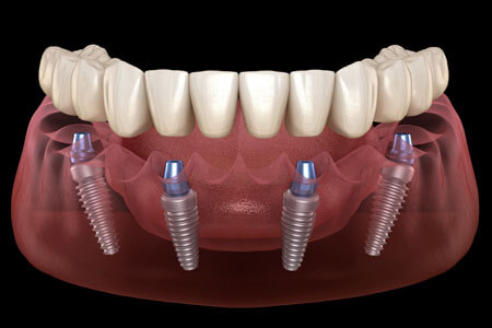 Picture of an all on four bottom