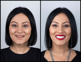 Picture of a before and after dental work with new crowns