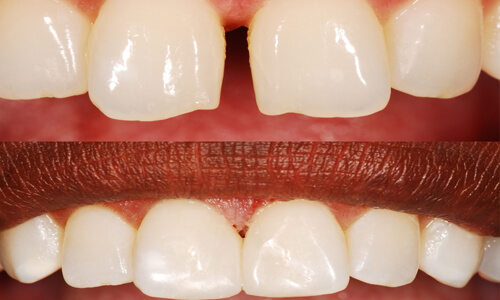 Illustration of a upper and lower teeth showing how a dental bonding procedure is done by the Costa Rica Dental Center in San Jose, Costa Rica.  The picture two damaged front teeth and the same teeth as repaired in a second view.