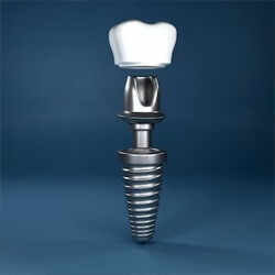Close up picture of a dental implant