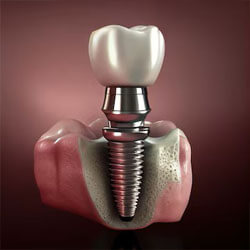 Picture of a dental implant with a crown