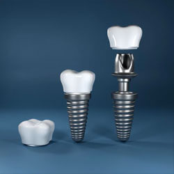 Close up picture of three dental implants