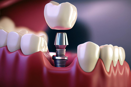 Ilustration of a dental implant going into the gum