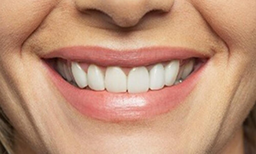 Picture of a woman with perfect teeth after having a dentures procedure done at the Costa Rica Dental Center in San Jose, Costa Rica.  The picture is a close-up of a perfect smile.