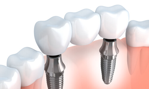 Illustration of an implant-supported bridge procedure done by the Costa Rica Dental Center in San Jose, Costa Rica.  The picture shows an implant-supported bridge being placed in the lower jaw.