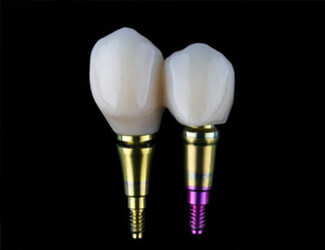 Picture of two crowns over dental implants